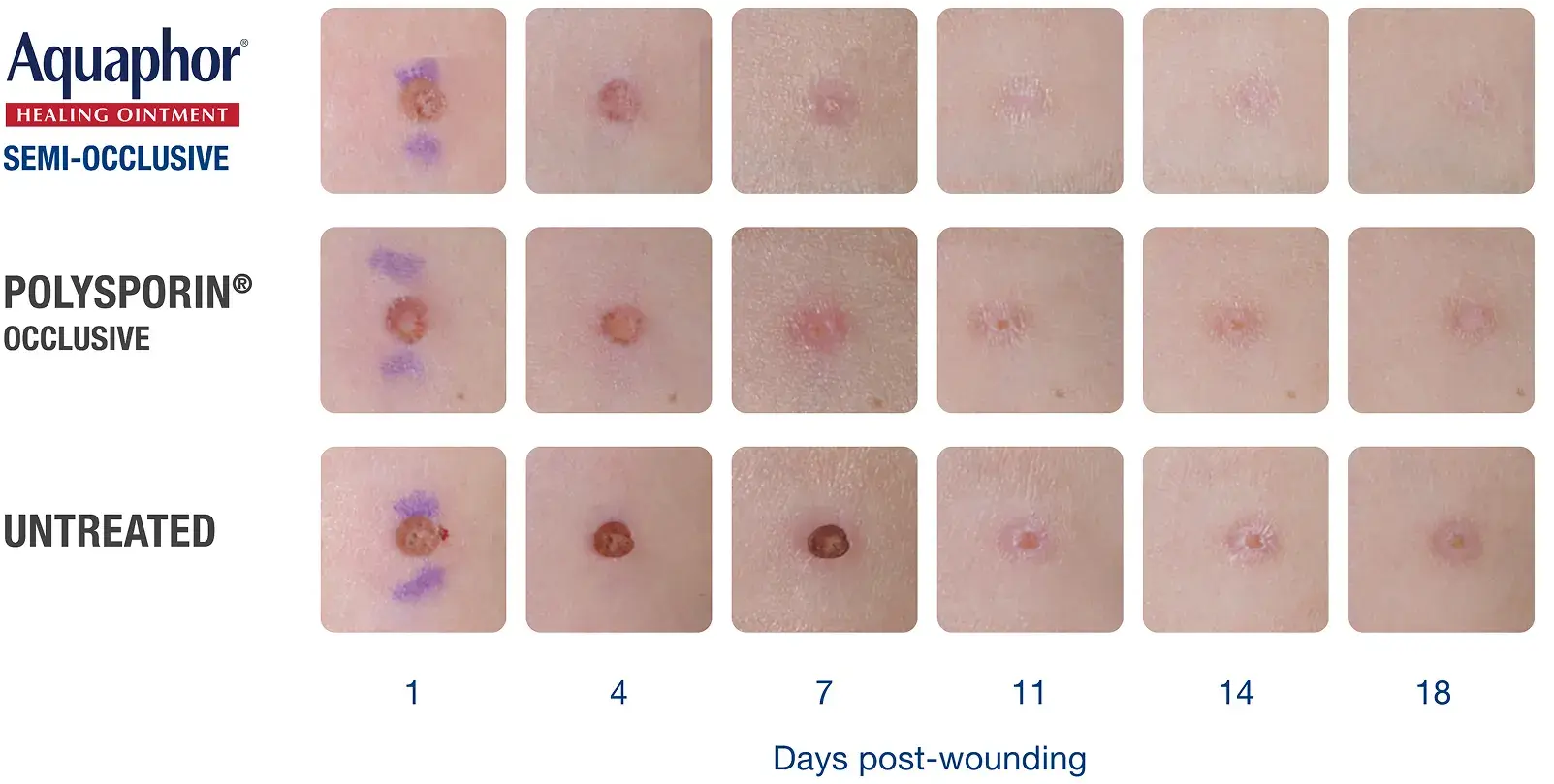Clinical study comparing Aquaphor Healing Ointment to Polysporin and Untreated skin
