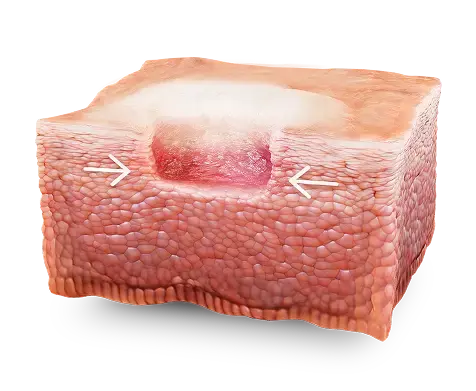 Skin graphic showing arrows pointing to a wound